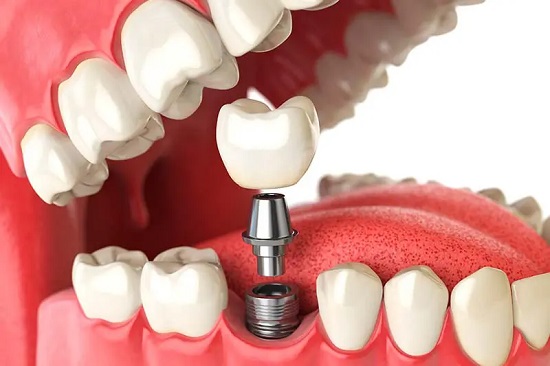 Tipos de implantes dental