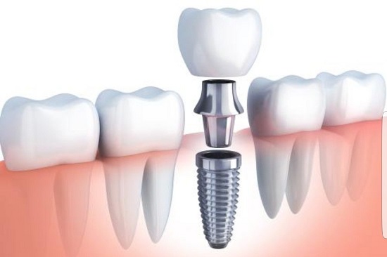 Tipos de implantes para los dientes